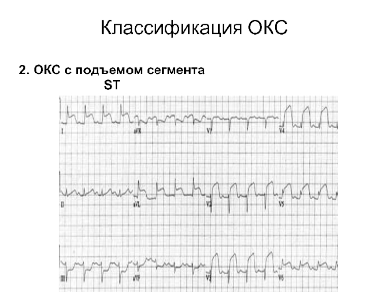 Карта вызова c окс c подъемом сегмента st