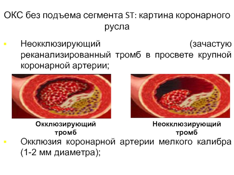 Острый коронарный синдром введение