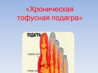 Хроническая тофусная подагра