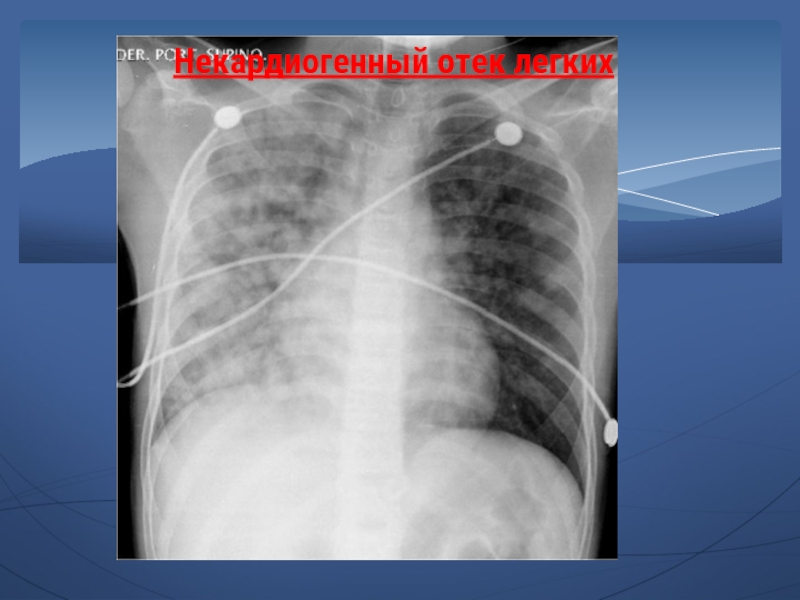 Некардиогенный отек легких презентация