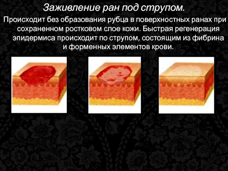 Почему плохо заживают раны на коже. Заживление РАН под струпом. Заживление под струпом фото. Заживление РАН регенерация тканей.