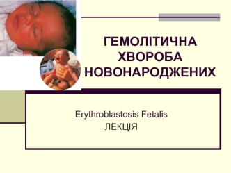 Гемолітична хвороба новонароджених