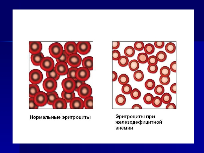 Уменьшение объема эритроцитов. Эритроциты при железодефицитной анемии. Железодефицитная анемия клетки крови. Гипохромия это в крови. Жда анемия гипохромная.