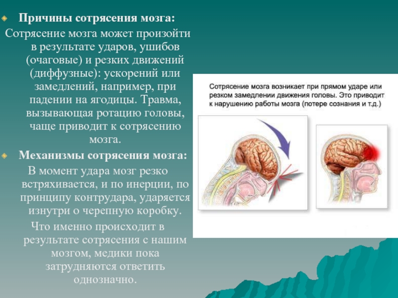 Сотрясение статья. Синдромы при сотрясении мозга. Механизм сотрясения головного мозга.