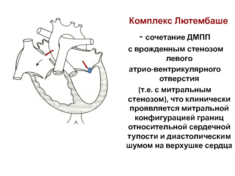 Для аускультативной картины дмпп характерно