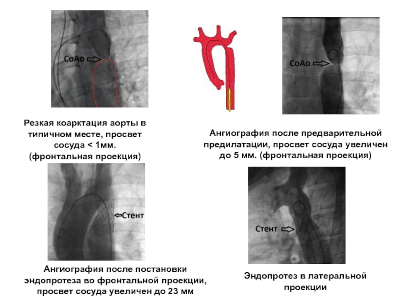 Коарктация аорты картинки