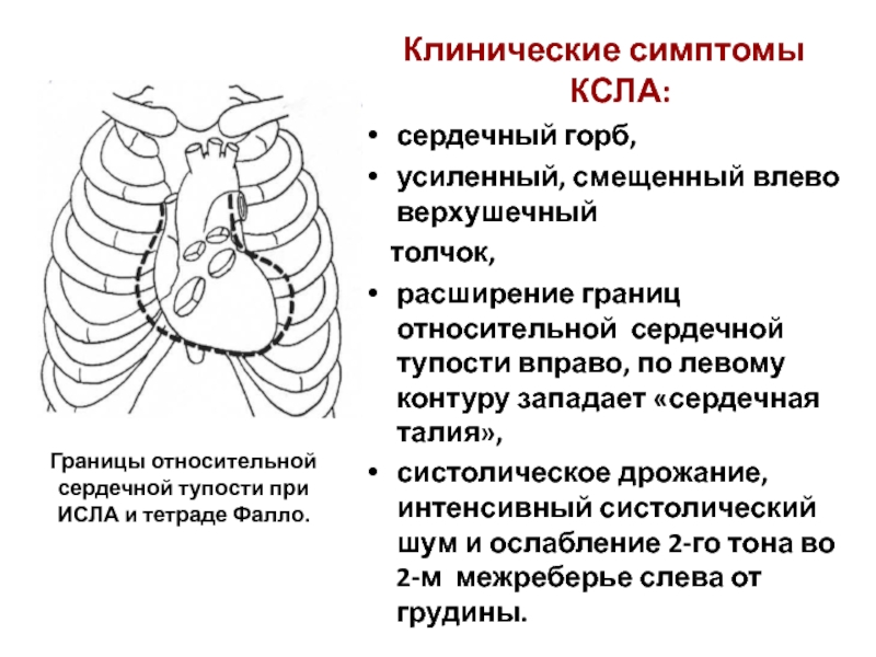 Сердечный горб это