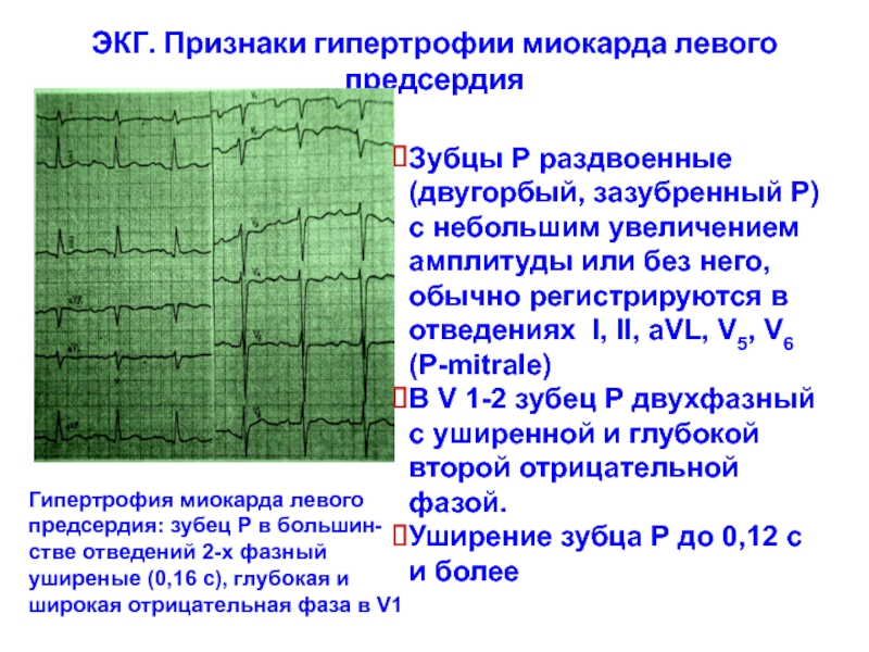 Экг отрицательный