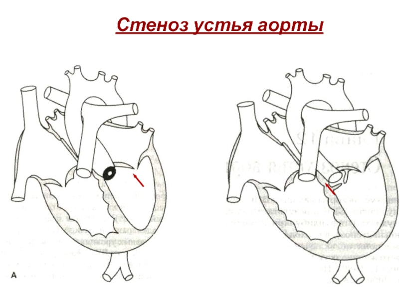 Аортальный стеноз рисунок