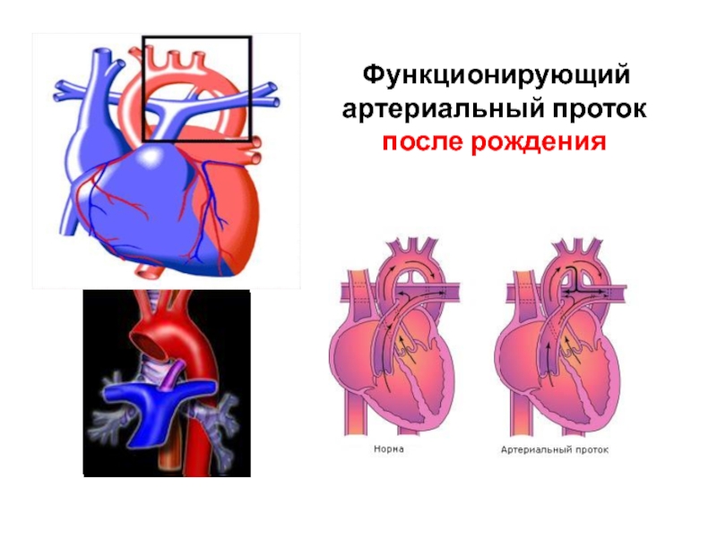 Открытый артериальный проток презентация