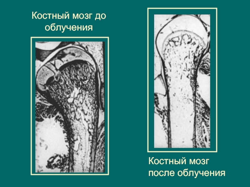 Пораженный костный мозг. Костномозговая форма острой лучевой болезни. Костный мозг до и после облучения. Поражение костного мозга. Костно-мозговая форма острой лучевой болезни.