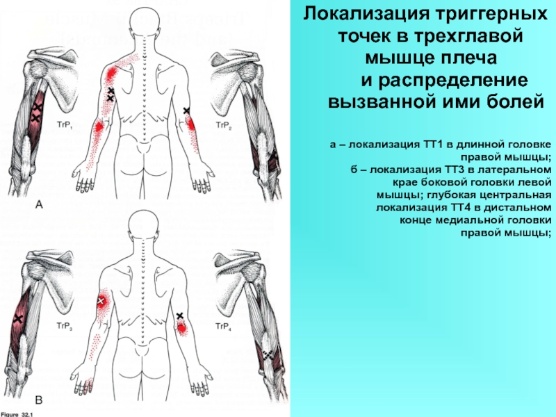 Триггерные точки на теле человека фото с описанием для снятия боли в плече