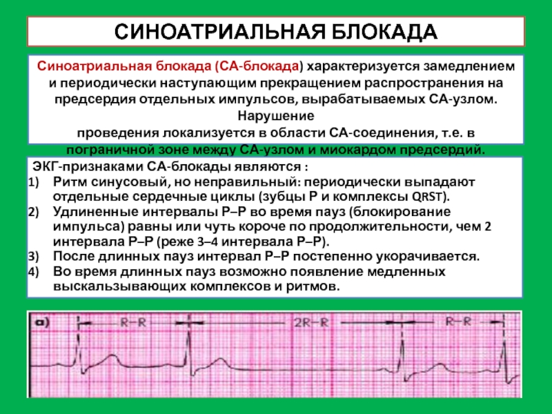 Лечение блокад. Синоатриальная тахикардия ЭКГ признаки.