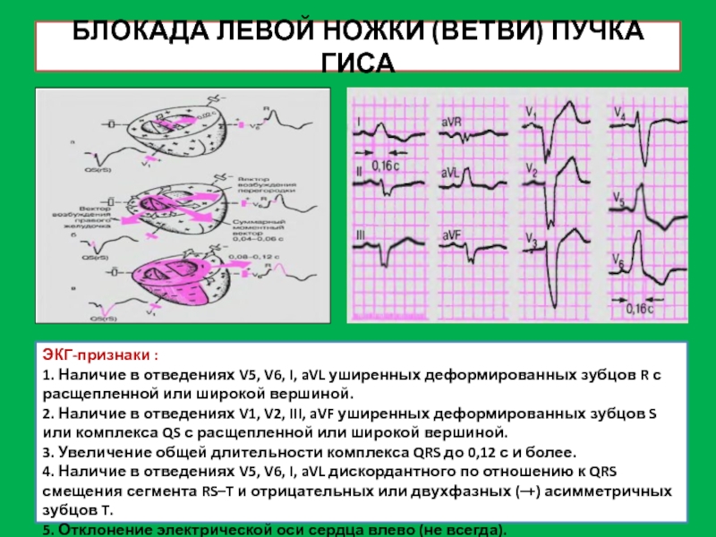 Ножки пучка гиса на экг. Двухфазный зубец р чаще всего регистрируется в норме в отведении.