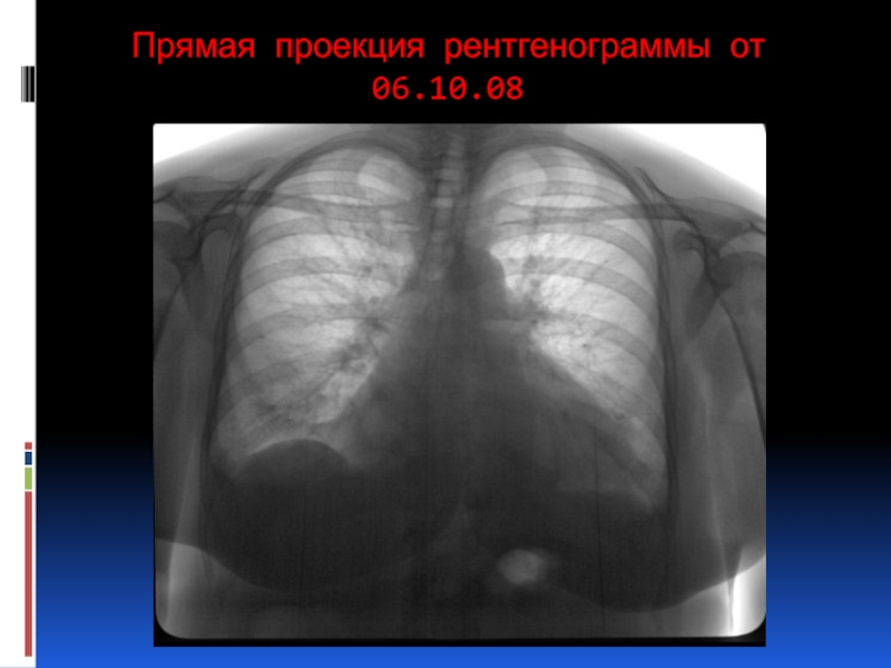 Прямая проекция рентгенограмма. Рентгенограмма прямая проекция. Флюорография прямая проекция. Косая проекция рентген. ФЛГ В прямой проекции.