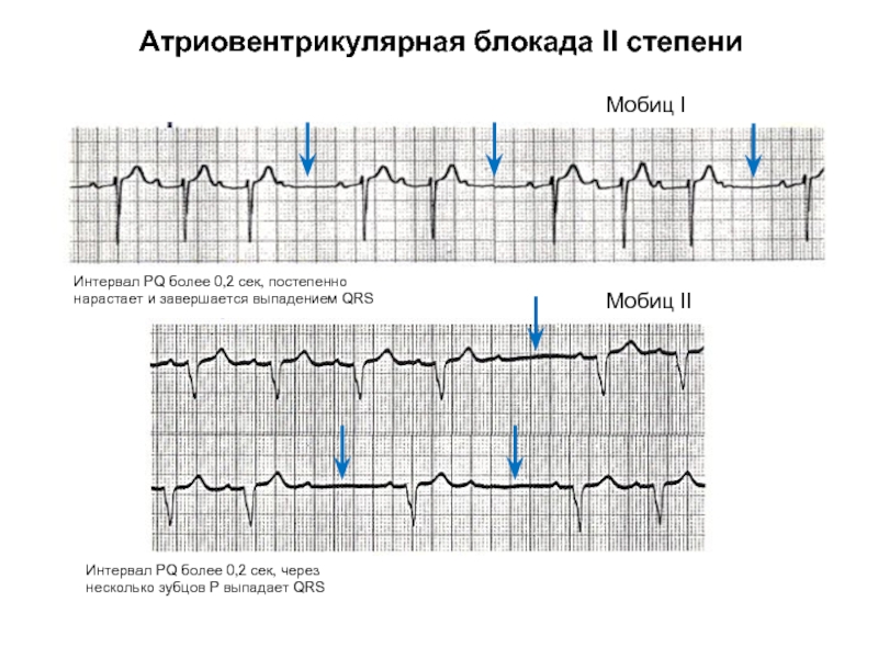 Са блокада 2 степени. Av блокада 2 степени Мобиц 2. Признаки av - блокады II степени (Мобиц 2). АВ блокада 2 степени с выпадением QRS. Av-блокада 3 степени, Мобиц 2..