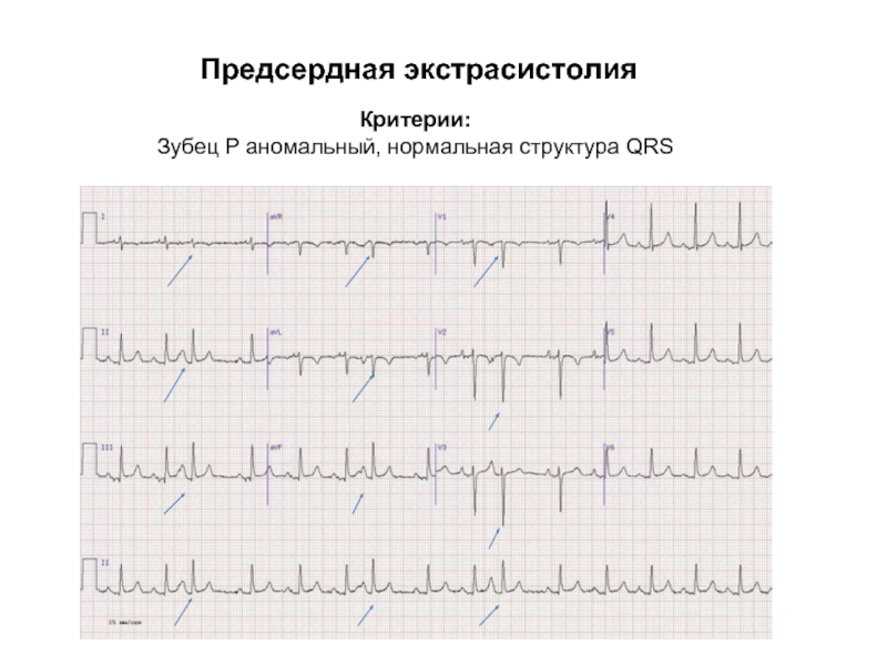 Предсердные экстрасистолы. Критерии предсердной экстрасистолии. Предсердная экстрасистолия клиника. Предсердная экстрасистолия лечение. Предсердная экстрасистолия причины.