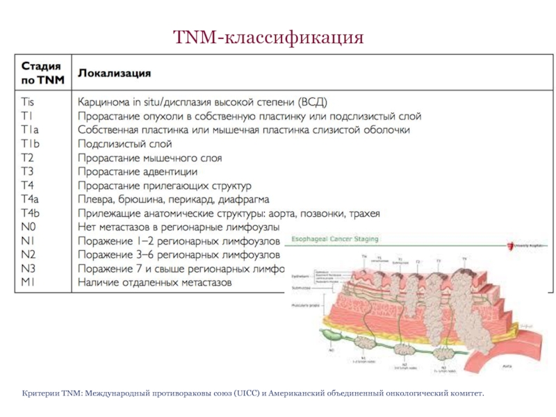 Рак пищевода метастазы