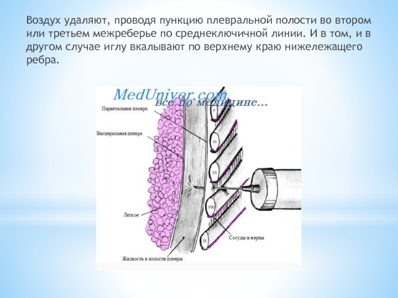 Полость проводиться. Плевральная пункция межреберье. Плевральная пункция по Нижнему краю ребра. Плевральная пункция по верхнему краю ребра. Пункция плевральной полости по какому краю ребра.