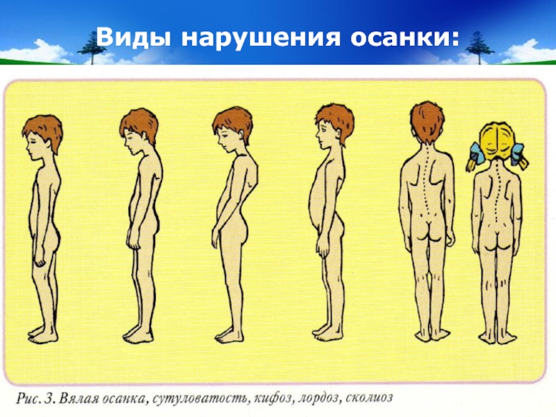 Рассмотрите рисунки 1 4 на каком из них изображен подросток с нормальной осанкой