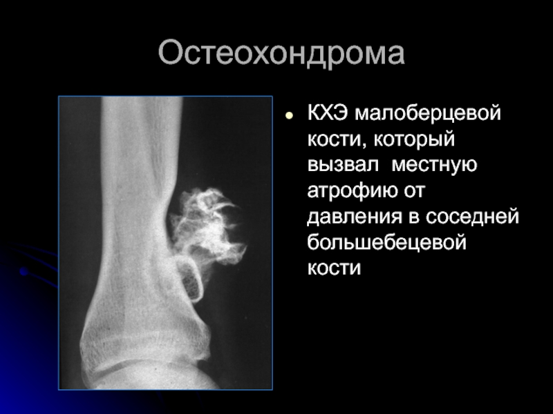 Остеохондрома бедренной. Остеохондрома таранной кости. Остеохондрома дистального метафиза бедренной кости. Остеохондрома бедренной кости кт. Остеохондрома большеберцовой кости кт.