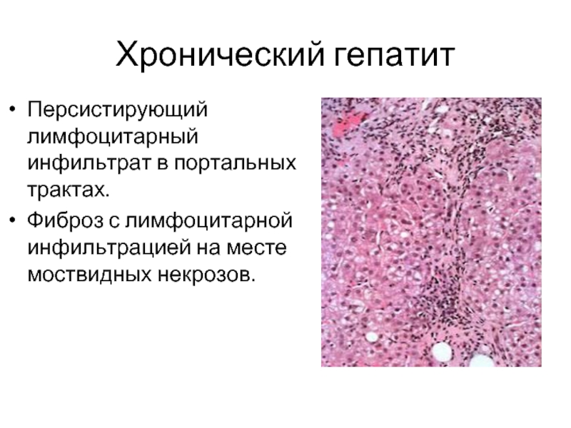 Лимфоцитарный тиреоидит