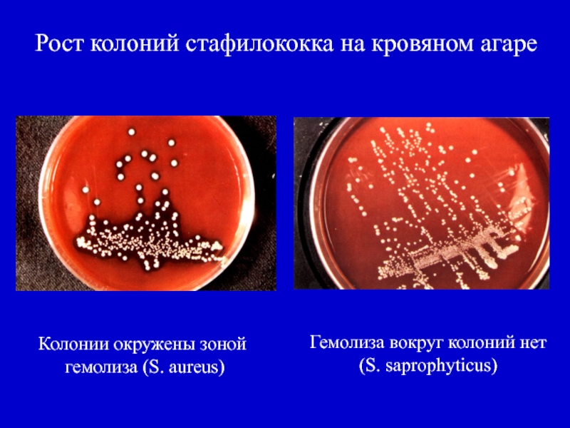 Staphylococcus aureus 4. Колонии стафилококка на кровяном агаре. Колонии стафилококков на кровяном агаре и ЖСА. Стафилококк ауреус гемолиз на кровяном агаре. Золотистый стафилококк гемолизин бета гемолиз на кровяном агаре.