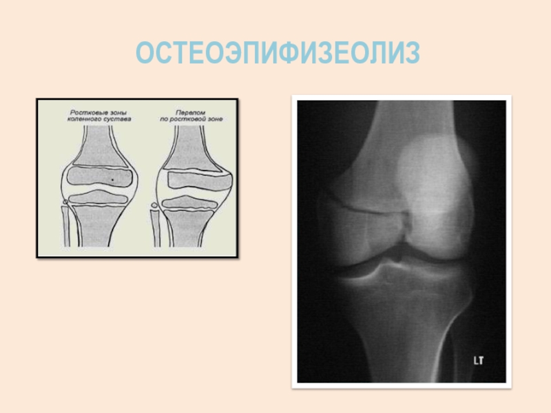 Эпифизеолиз это. Остеоэпифизеолиз дистального метаэпифиза большеберцовой кости. Остеоэпифизеолиз большеберцовой кости у ребенка. Остеоэпифизеолиз большеберцовой кости. Остеоэпифизеолиз лучевой кости.