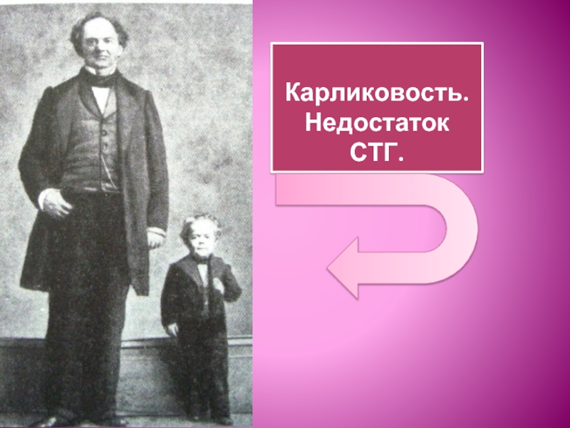 Карликовость железа. Карликовость при нормальном СТГ.