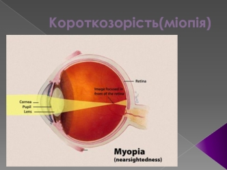 Короткозорість (міопія)