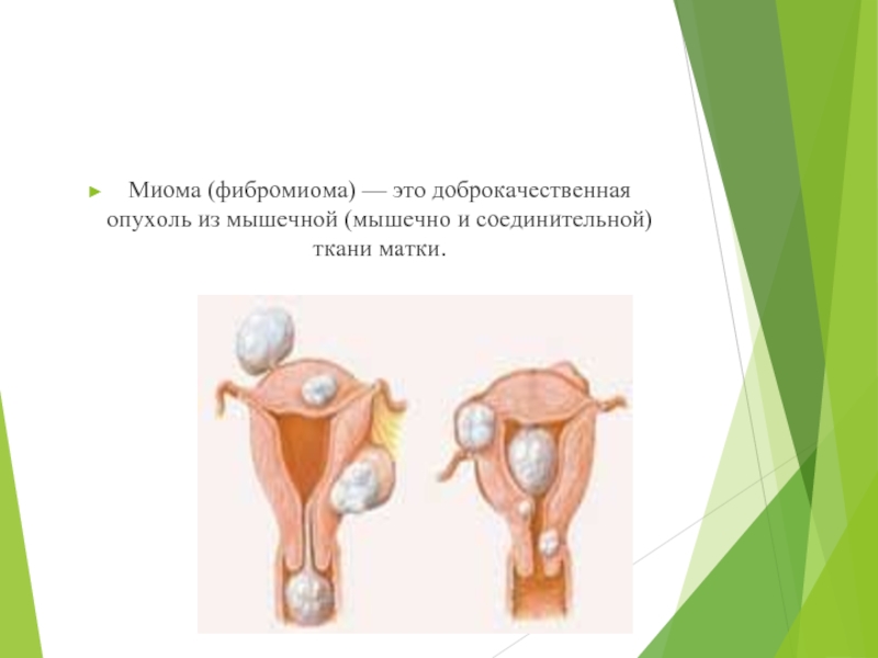 Доброкачественная мышечная опухоль