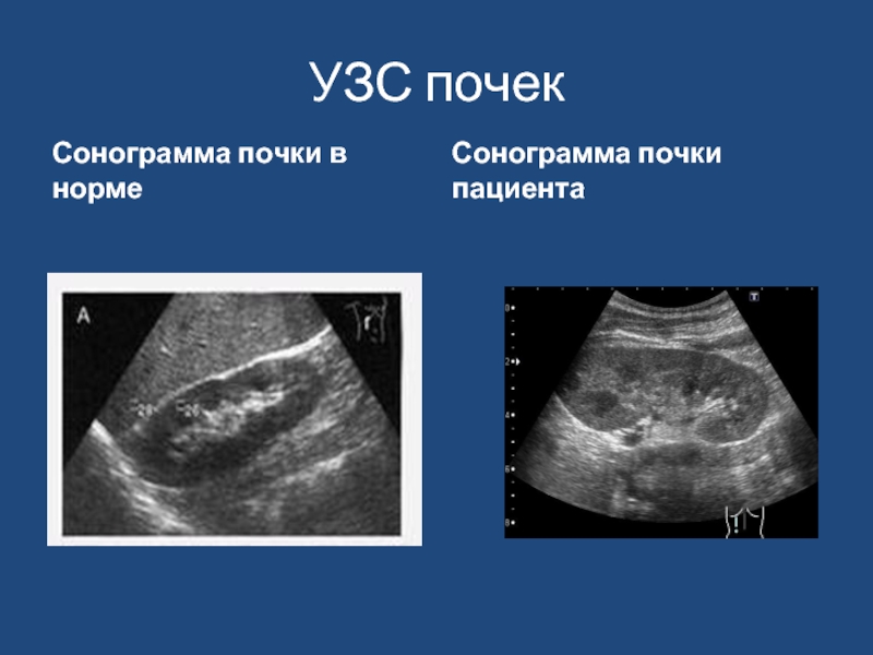 Сонограмма это. УЗИ почек сонограмма. Сонограмма почки. Сонограмма левой почки. Доплер почек сонограмма.