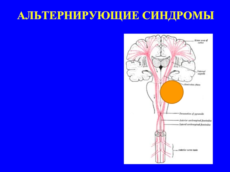 Синдром мийяра гюблера. Альтернирующие синдромы. Синдром Мийяра Гюблера Жюбле. Альтернирующие синдромы на срезах. Оптико пирамидный синдром.