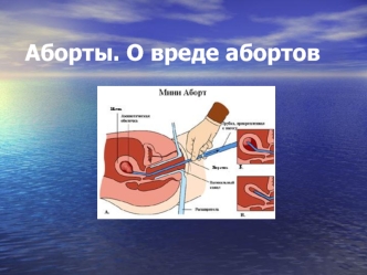 Аборты. О вреде абортов