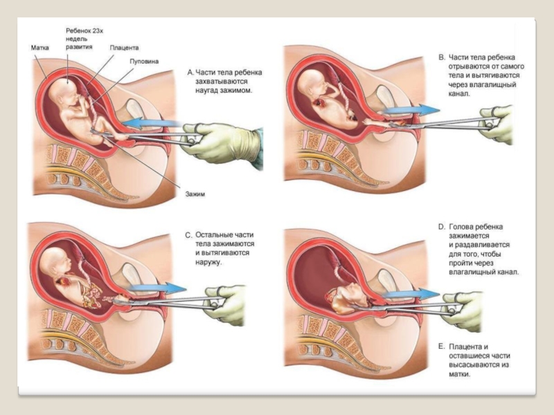 Реферат: Типичные гинекологические операции