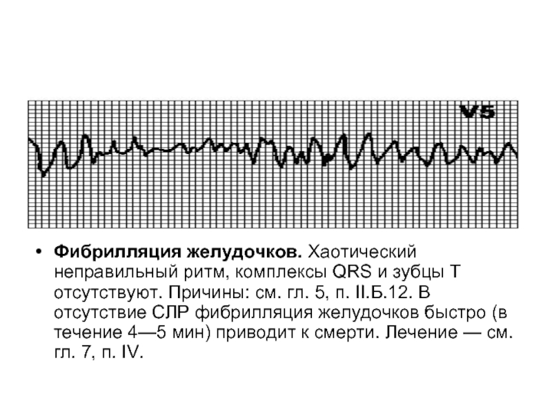 Фибрилляция желудочков фото