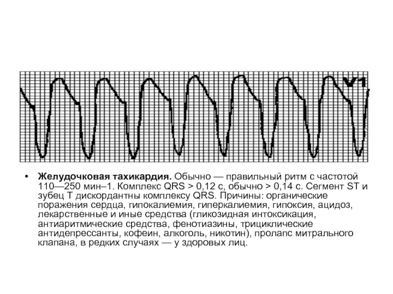 Правильный ритм. Желудочковая тахикардия частота. Желудочковая тахикардия ритм. Правильный желудочковый ритм. Частота при желудочковой тахикардии.