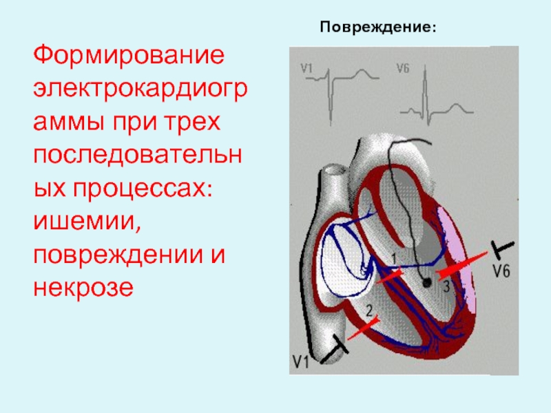 Тоны сердца при инфаркте миокарда. Повреждение миокарда. Дефект межпредсердной перегородки ЭКГ. Повреждение ишемия некроз миокарда.