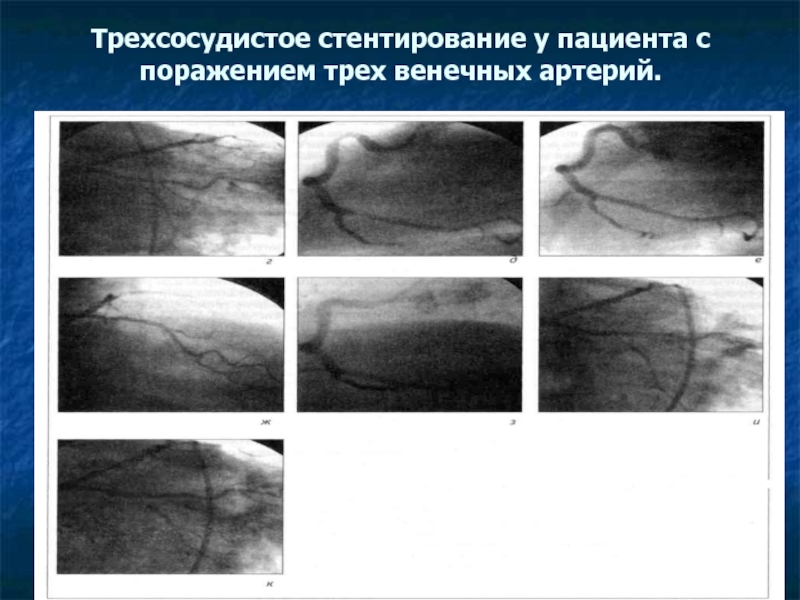 Жизнь после инфаркта и стентирования для мужчин. Поражение коронарных артерий. Трехсосудистое поражение коронарных артерий. Трехсосудистре поражение артерии. Протокол операции стентирование коронарных артерий.