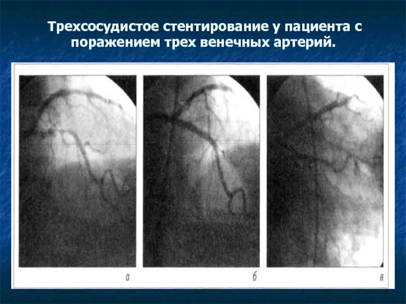 Поражения коронарных сосудов. Трехсосудистое поражение коронарных артерий. Трехсосудистре поражение артерии. Трехсосудистое поражение коронарного русла что это. Многососудистое поражение сердца.