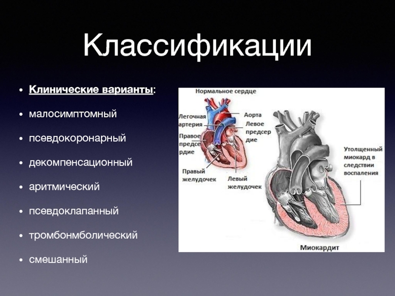 Миокардит картинки для презентации