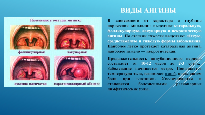 Реферат: Ангина