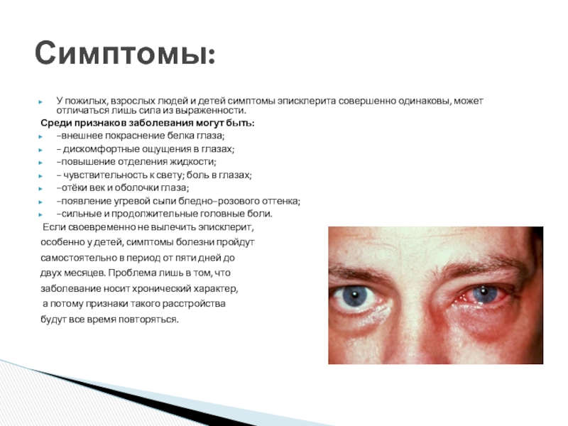 Признаки больных глаз. Заболевание глаз эписклерит. Эписклерит глаза у детей симптомы.