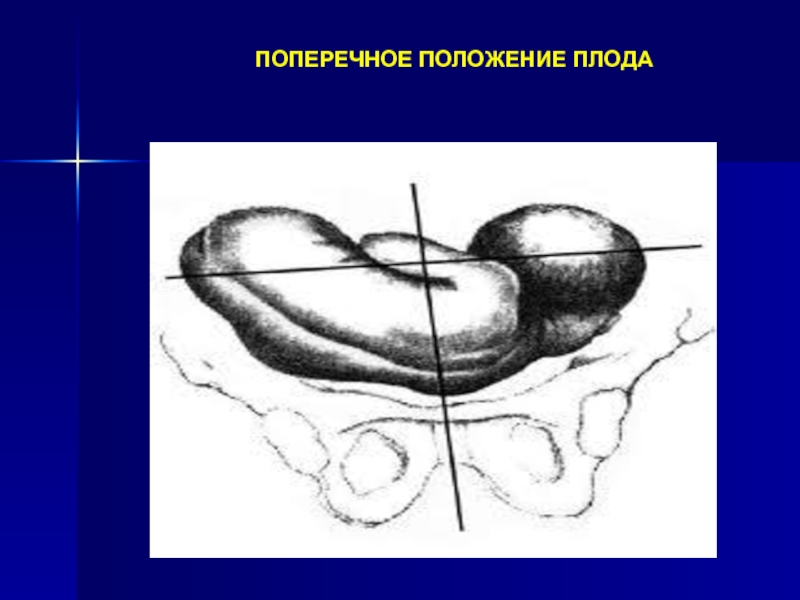 Поперечное положение. Поперечное положение плода. Запущенное поперечное положение плода. Поперечное положение плода упражнения.