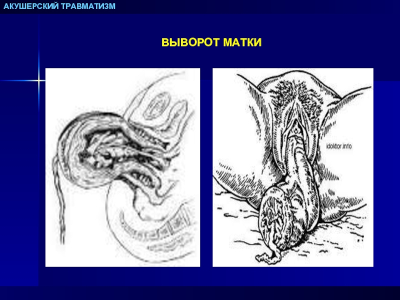 Задняя матка. Послеродовый выворот матки. Вправление выворота матки.