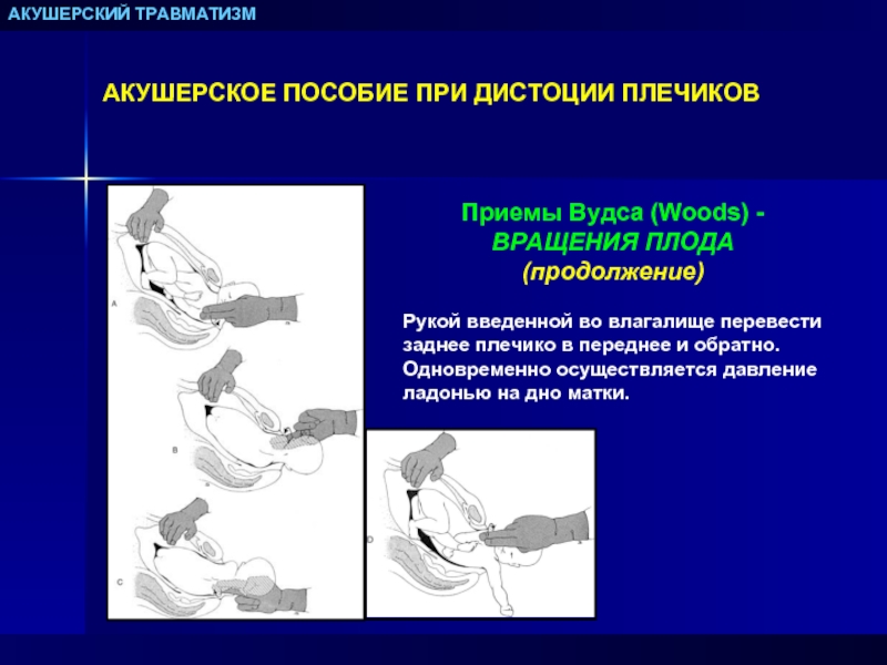 Дистоция плечиков презентация