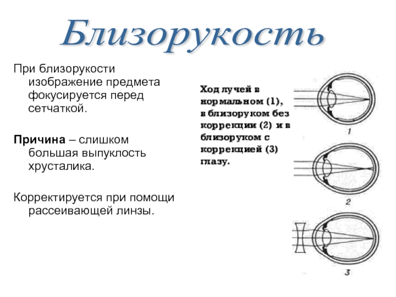 При близорукости изображение предмета возникает