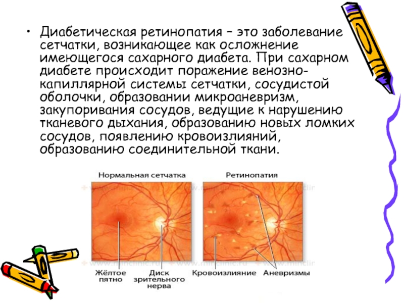 Диабетическая ретинопатия это. Заболевания сетчатки и зрительного нерва. Микроаневризмы сетчатки. Диабетическая ретинопатия жалобы. Ретинопатия при сахарном диабете.