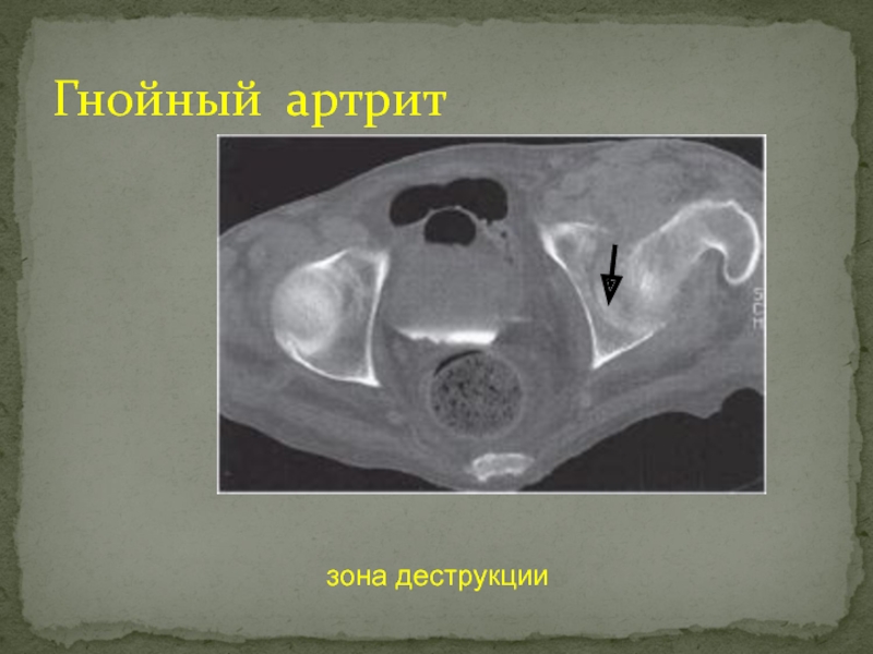 Для рентгенологической картины фолликулярной кисты характерна деструкция костной ткани в виде