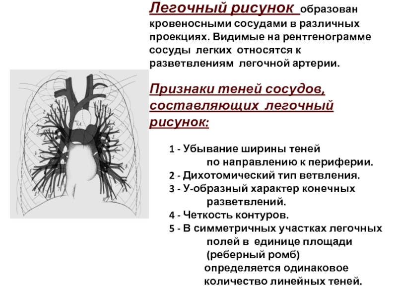 Легочный рисунок на рентгенограмме